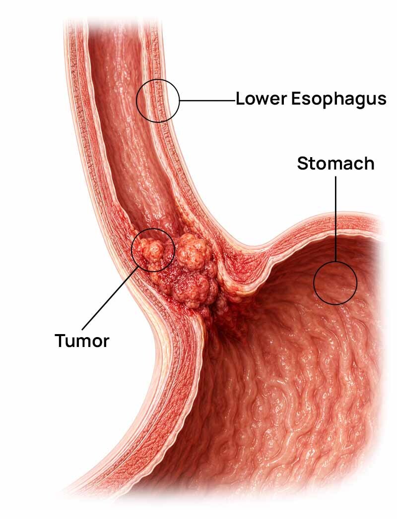 Diagram of the lower esophagus and stomach, where adenocarcinoma arises.